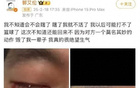 "郭艾倫談傷情，首反應(yīng)視受損"