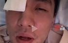 郭艾倫眼傷曝光，涉事隊友已道歉；臺灣球員或失明，專家評估。